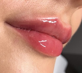 Lippenunterspritzung Dresden